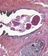 前列腺癌的细胞。