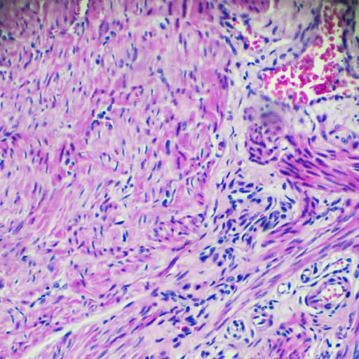 显微镜下子宫内膜癌生物标本
