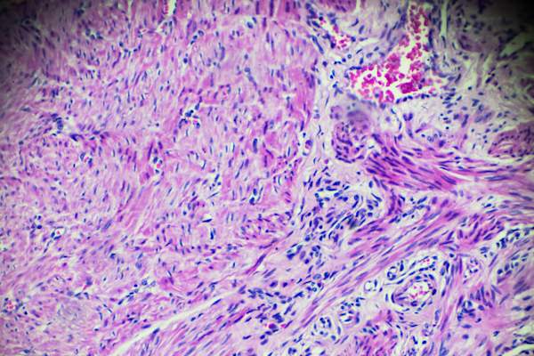 显微镜下子宫内膜癌生物标本