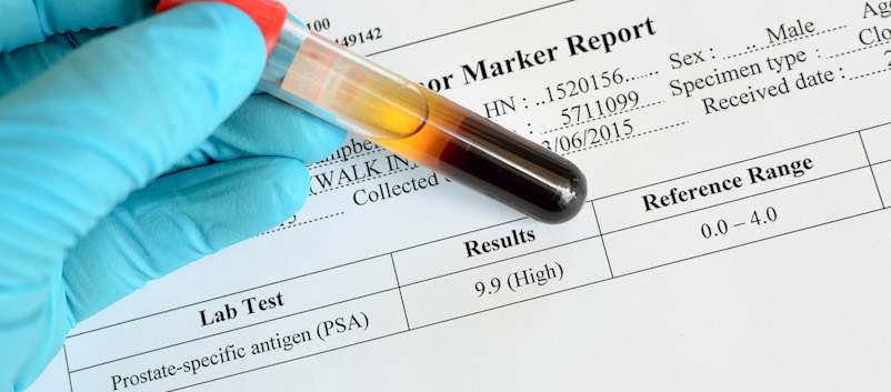 前列腺癌的测试