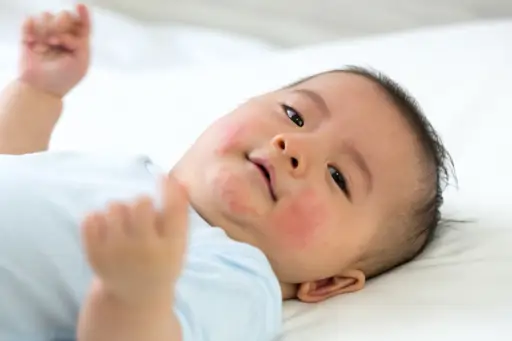 婴儿用湿疹在脸上