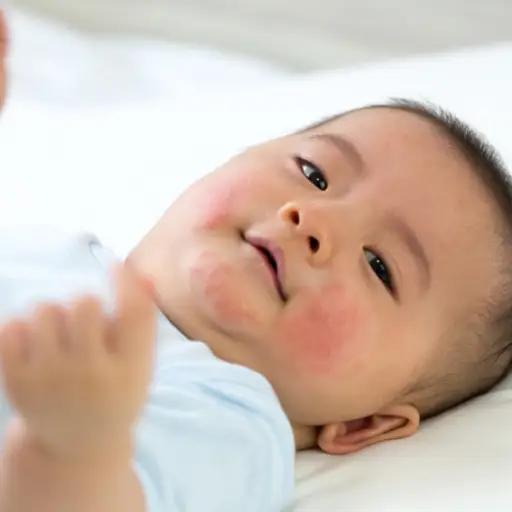 婴儿用湿疹在脸上