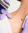 medical laser treatment