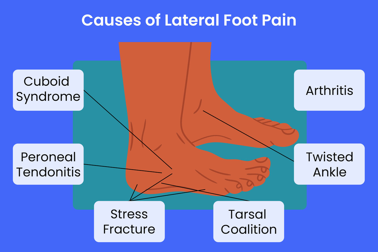 Lateral Foot Pain: Symptoms, Causes and Treatment