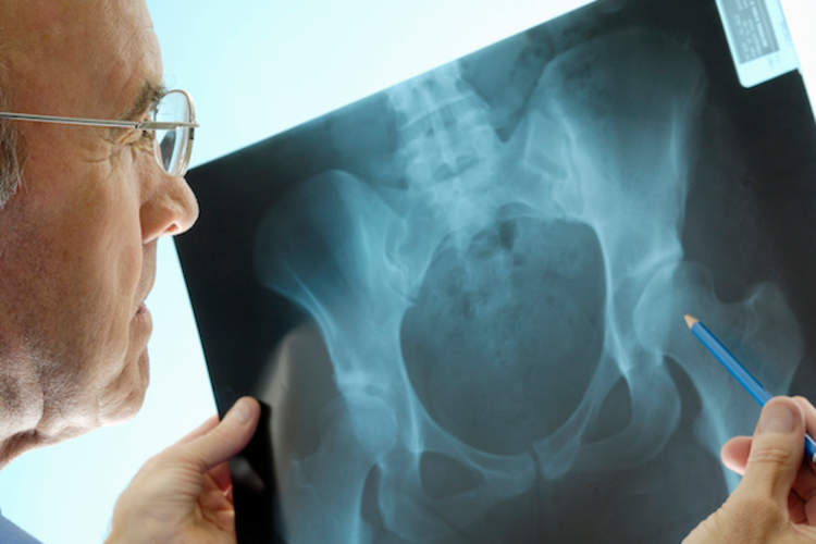 患有肺部疾病的女性患骨质疏松症的风险更高