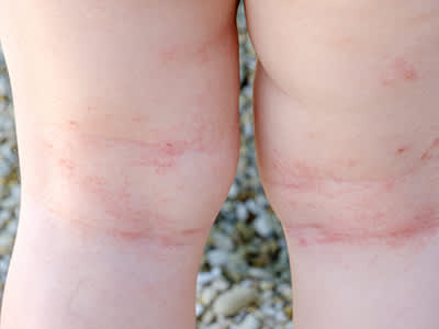 湿疹幼儿的腿后面。
