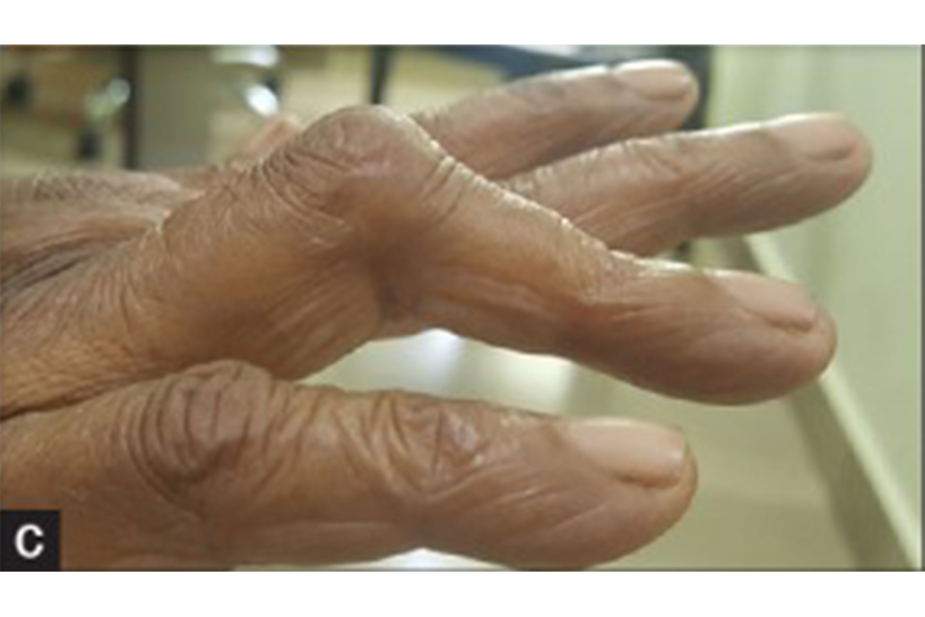 rheumatoid arthritis thumb