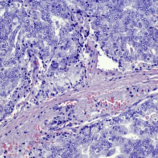 转移性前列腺癌的显微照片