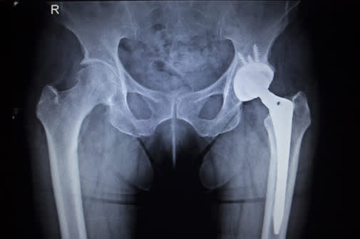 下脊柱和髋关节置换术的X线表现。