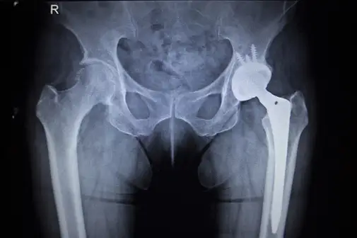低脊柱和髋关节置换的X射线。
