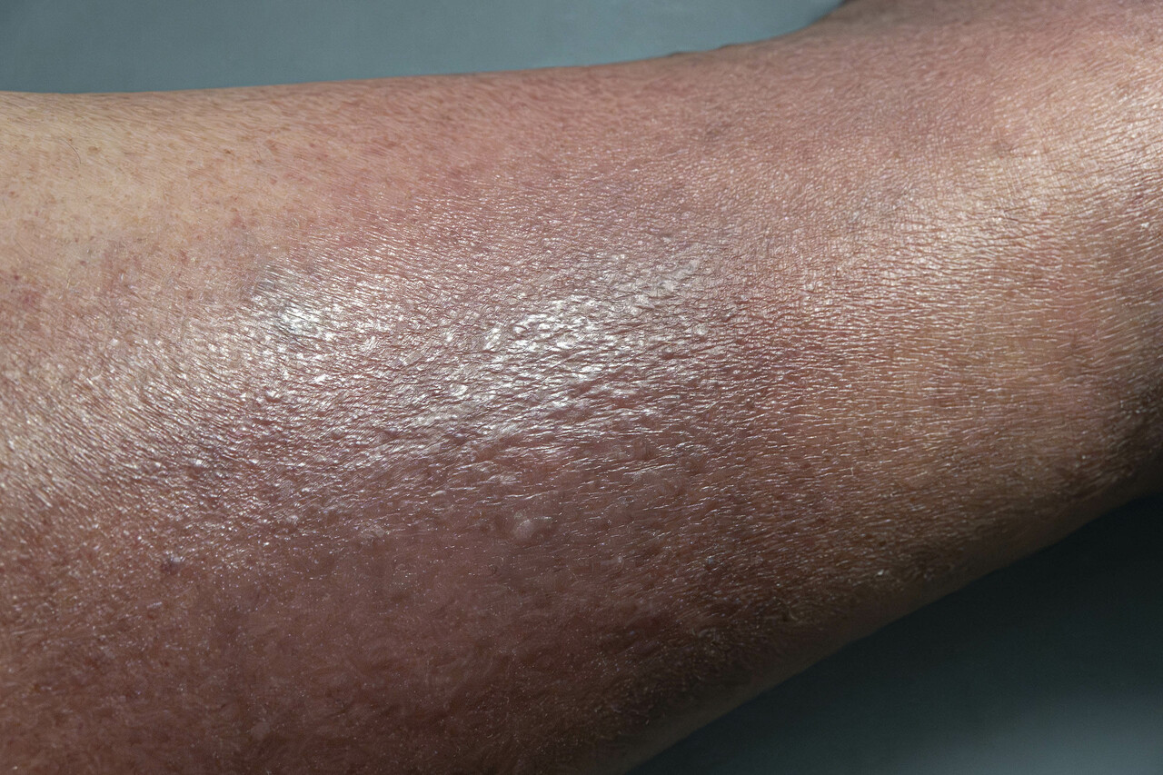 venous-stasis-dermatitis-symptoms-causes-and-treatments