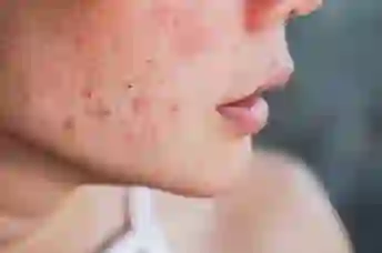 特写皮疹在女人的脸上