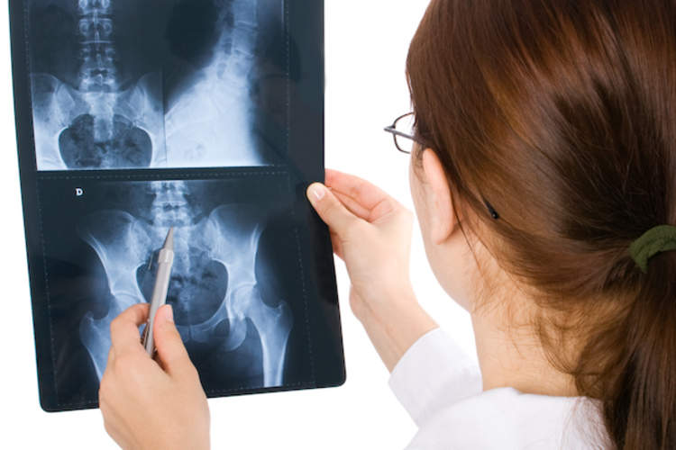 医生检查病人脊椎的x光片。