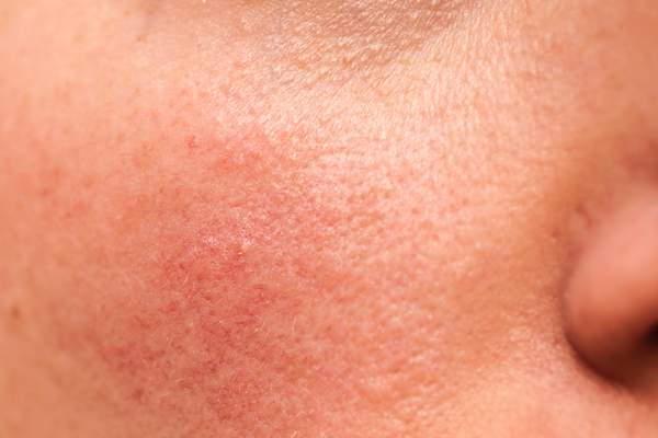 红斑痤疮