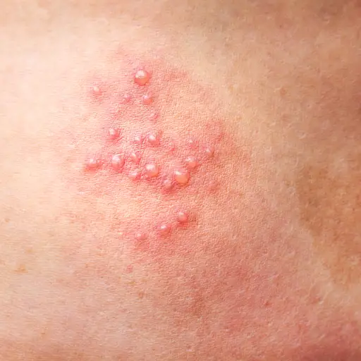 shingles blisters