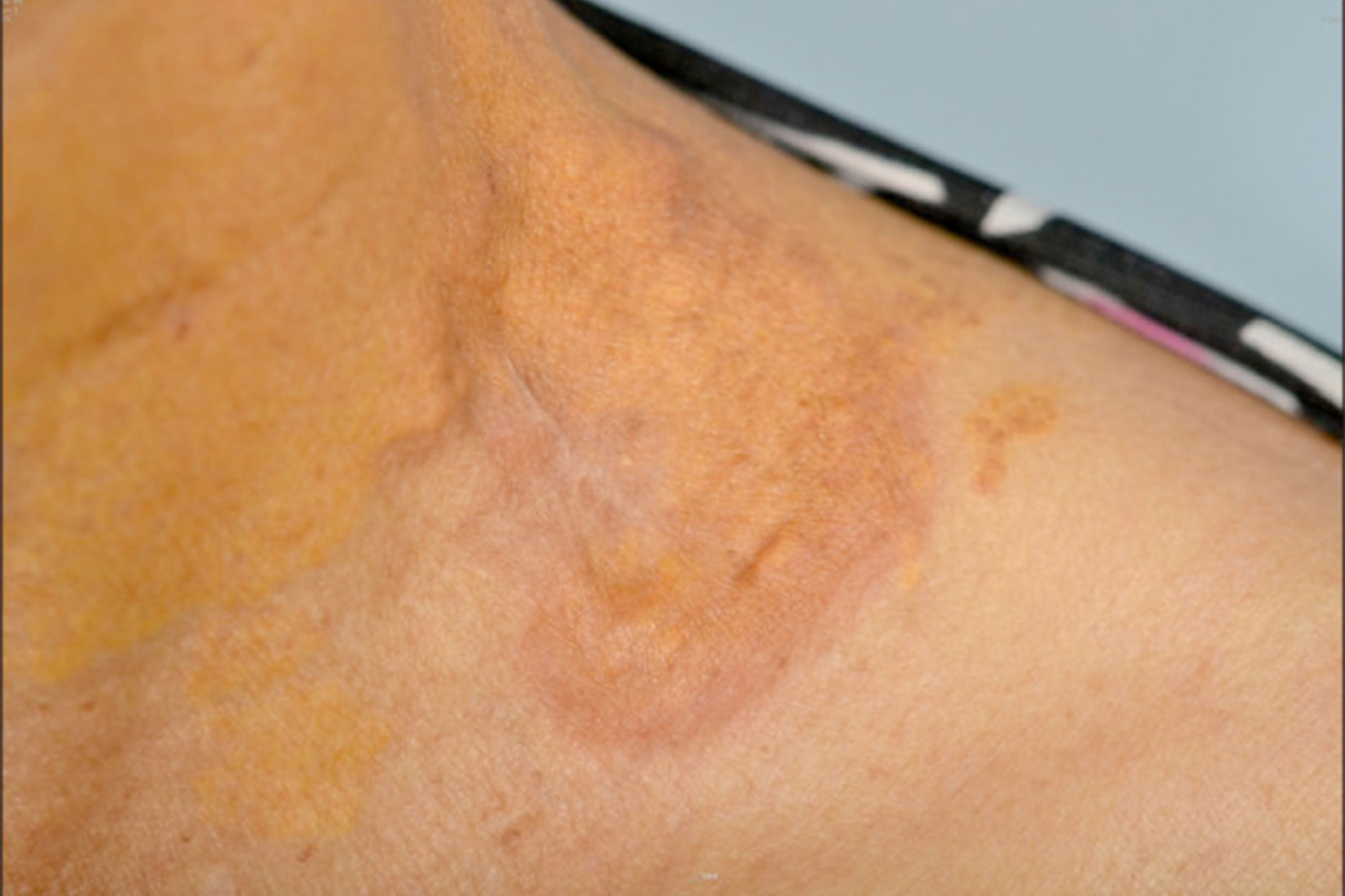 What Are Cholesterol Deposits?, image size:3000x2000