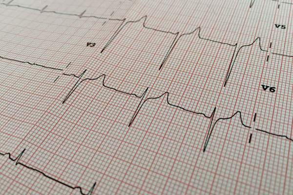 心电图结果写在纸上