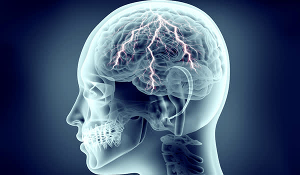 人体头部的X射线以闪电般的大脑中，疼痛的概念。