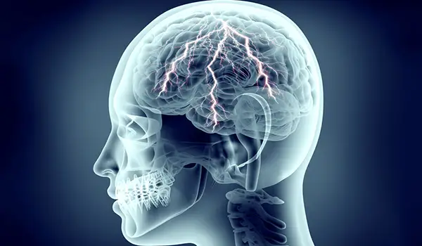 人脑中有闪电的头部x光片，疼痛概念。