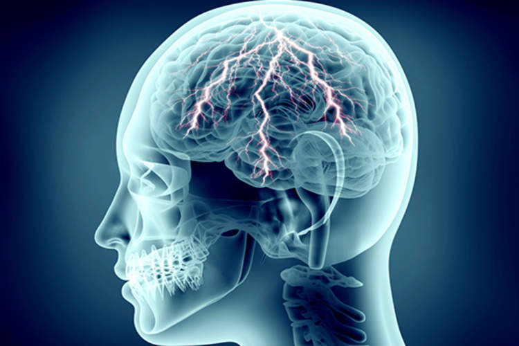 人体头部的X射线以闪电般的大脑中,疼痛的概念。