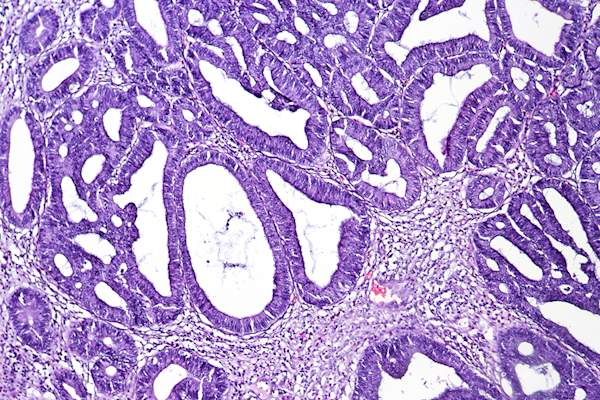 结肠腺瘤伴高度发育不全