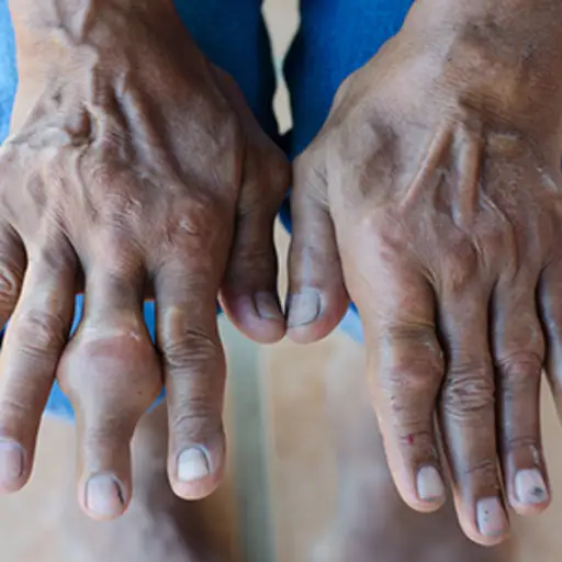 Fingers of a gout patient.
