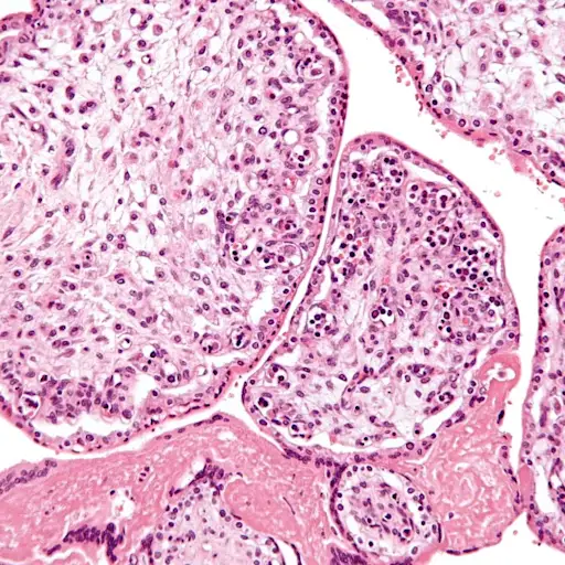 Micrograph showing Parvovirus infection