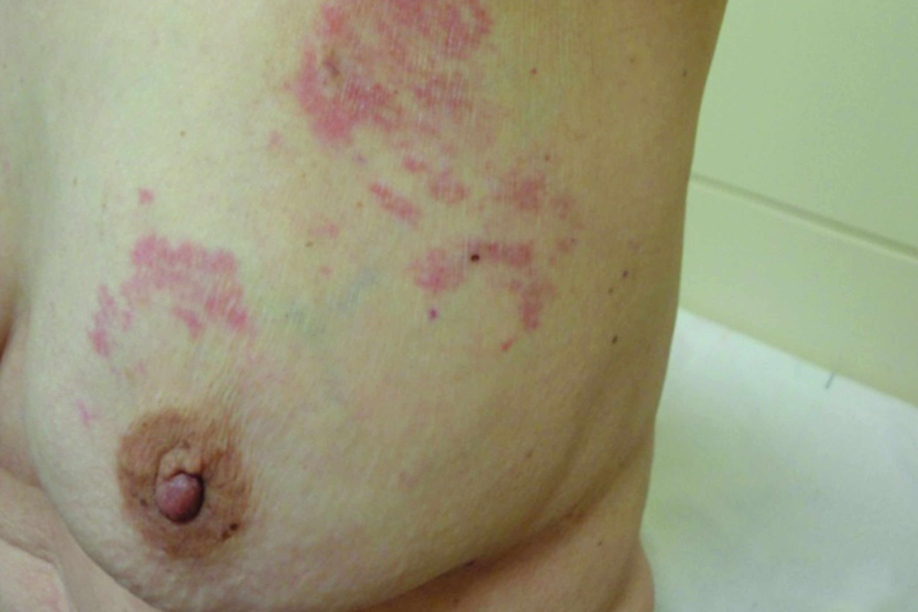 Breast Eczema: Symptoms, Causes and Treatment