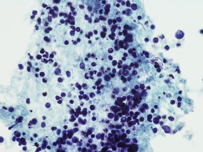 小细胞肺癌的显微照片