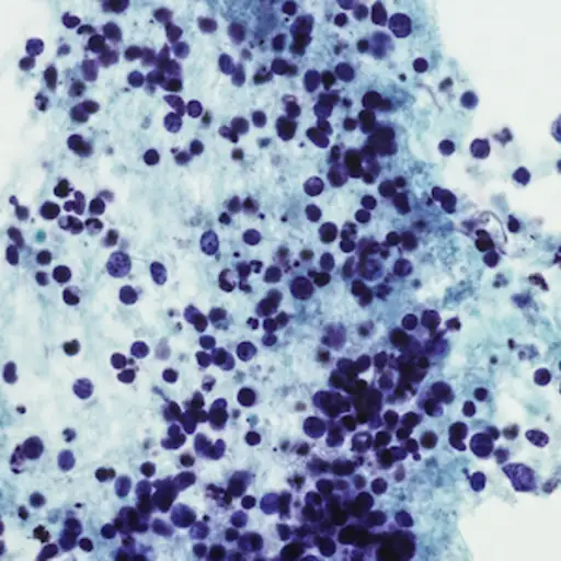 小细胞肺癌的显微照片