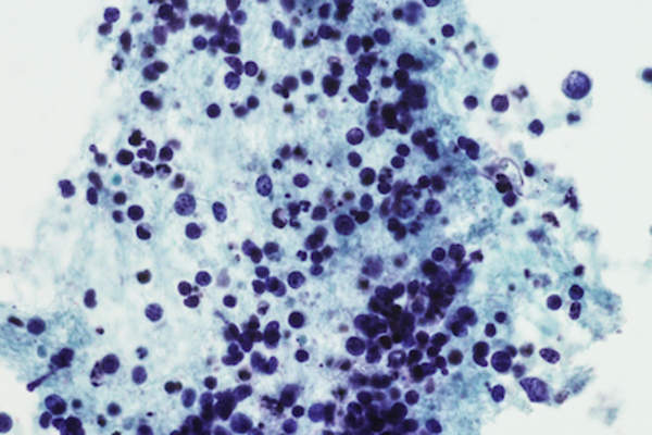 小细胞肺癌的显微照片