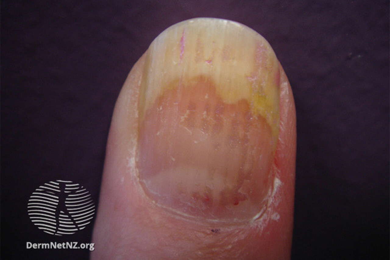 Nail Psoriasis May Predict Worse Psoriatic Arthritis Outcomes - Advances in  RA, PsO, PsA, and Related Disorders