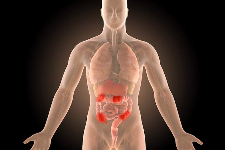 三维男性模型与克罗恩的感染部位突出