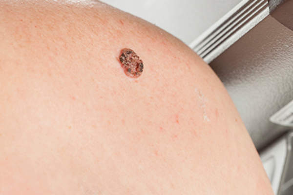 Keratinizing squamous cell carcinoma of the skin