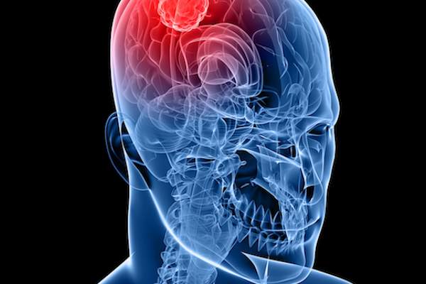 其它神经系统疾病