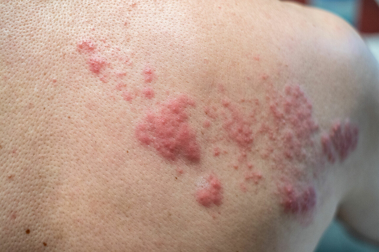 What Does Shingles Look Like? Shingles Rash Pictures