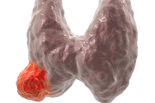 甲状腺癌模型。