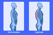 WHAT IS KYPHOSIS SYMPTOMS CAUSES DIAGNOSIS AND MORE Chiid Health WHAT IS KYPHOSIS SYMPTOMS CAUSES DIAGNOSIS AND MORE Chiid Health