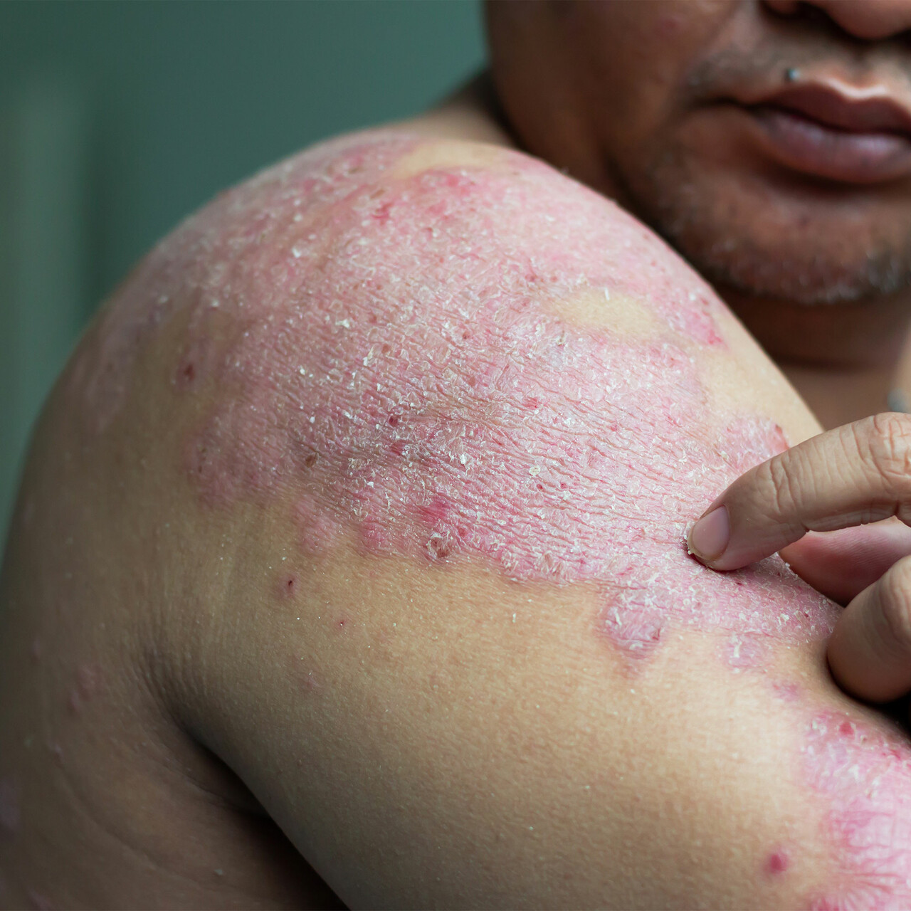 牛皮癣的特写一个男人的肩膀和手臂