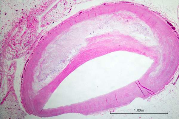 冠状动脉前降支闭塞