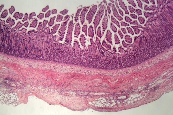 与炎症人体大肠部分的显微镜照片
