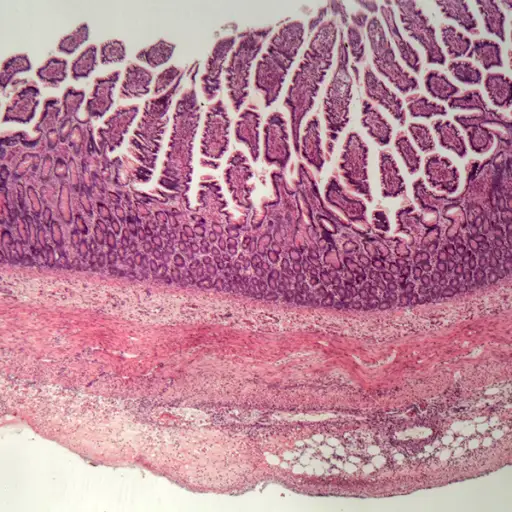 人类大肠部分的显微镜照片与炎症的