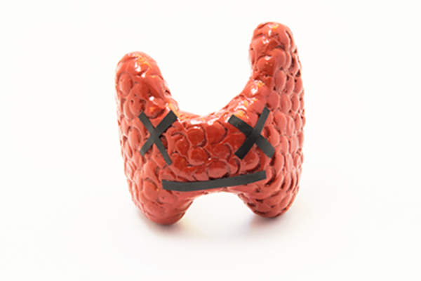 甲状腺模型展示功能障碍。