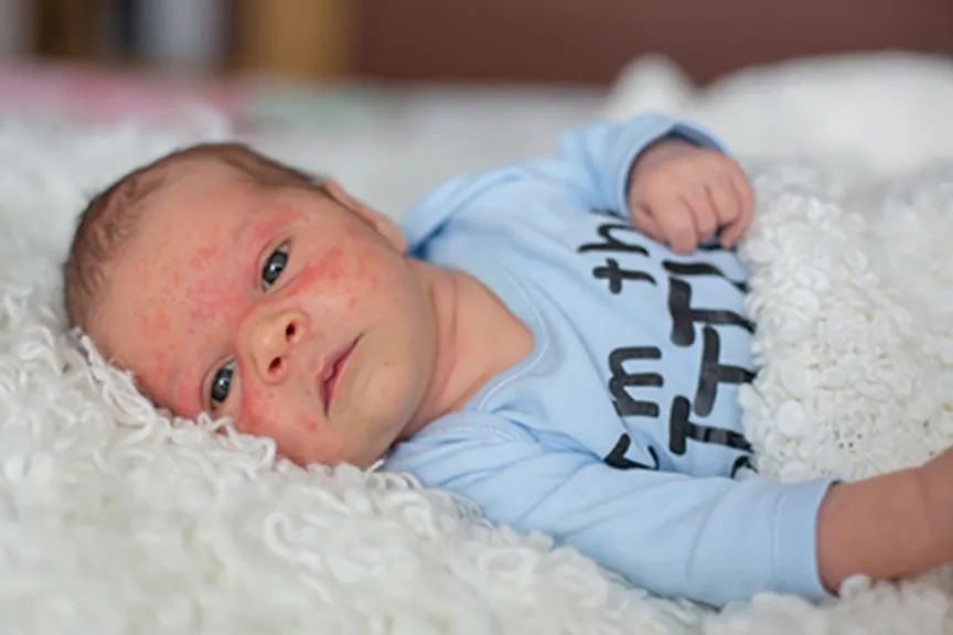 婴儿用湿疹。
