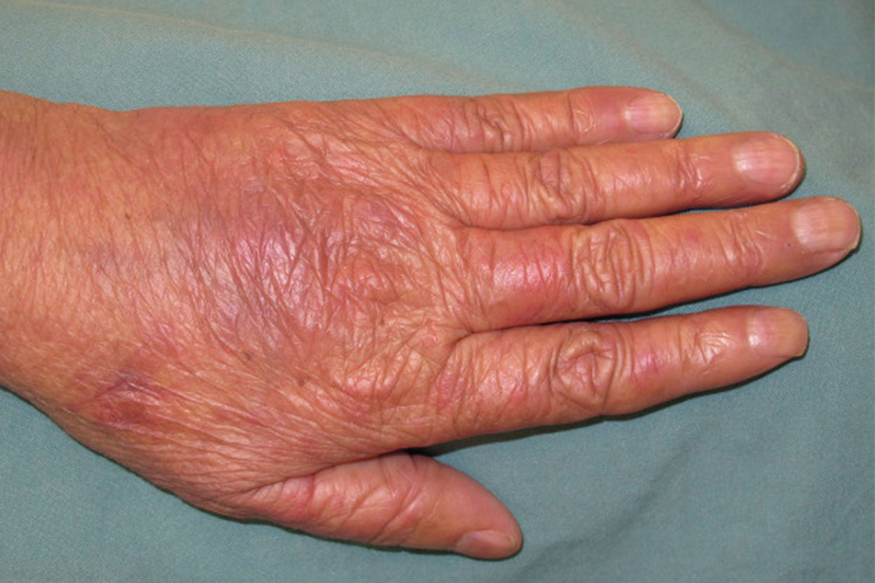 Caring For Your Skin and Nails During Cancer Treatment - Penn Medicine  Lancaster General Health