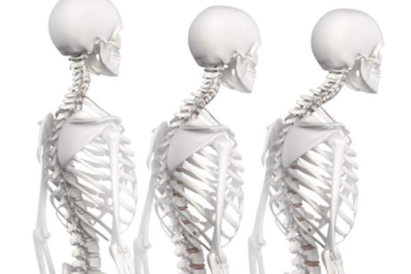 脊柱后凸分3期。