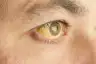 黄疸眼睛