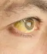 黄疸的眼睛
