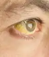 黄疸的眼睛