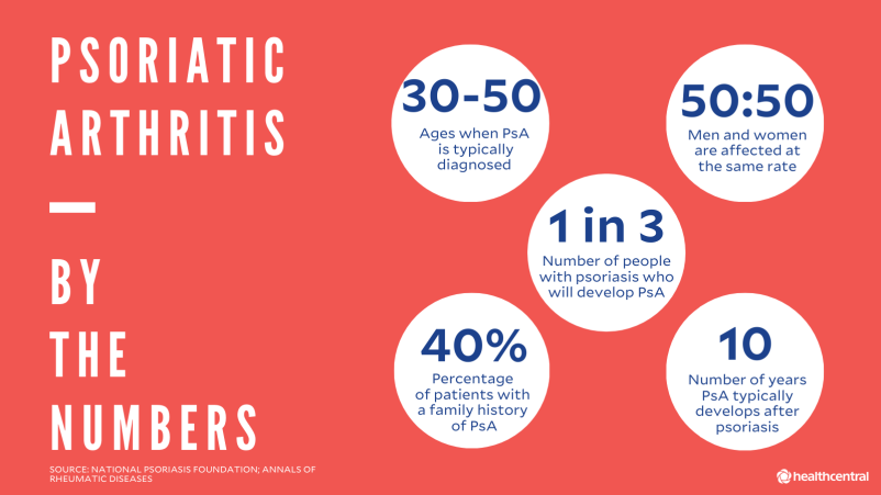 银屑病关节炎的统计:PsA诊断时的年龄，PsA对男性和女性的影响相等，银屑病患者中发生PsA的人数，有PsA家族史的患者的百分比，银屑病后PsA发生的年数